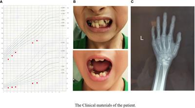 A Chinese Case of Cornelia de Lange Syndrome Caused by a Pathogenic Variant in SMC3 and a Literature Review